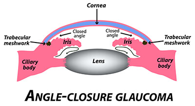 Closed-Angle Glaucoma Diagram