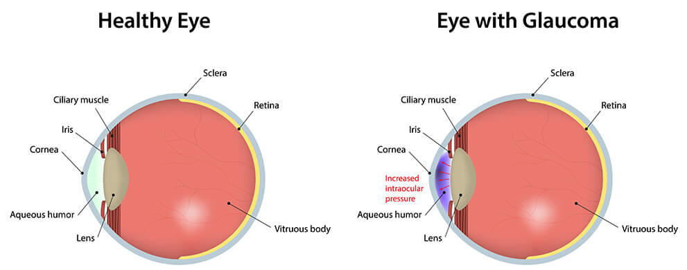 Healthy Eye vs Glaucoma diagram